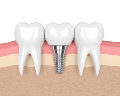 Dental Implants | Twin City Dental in Kelso, WA